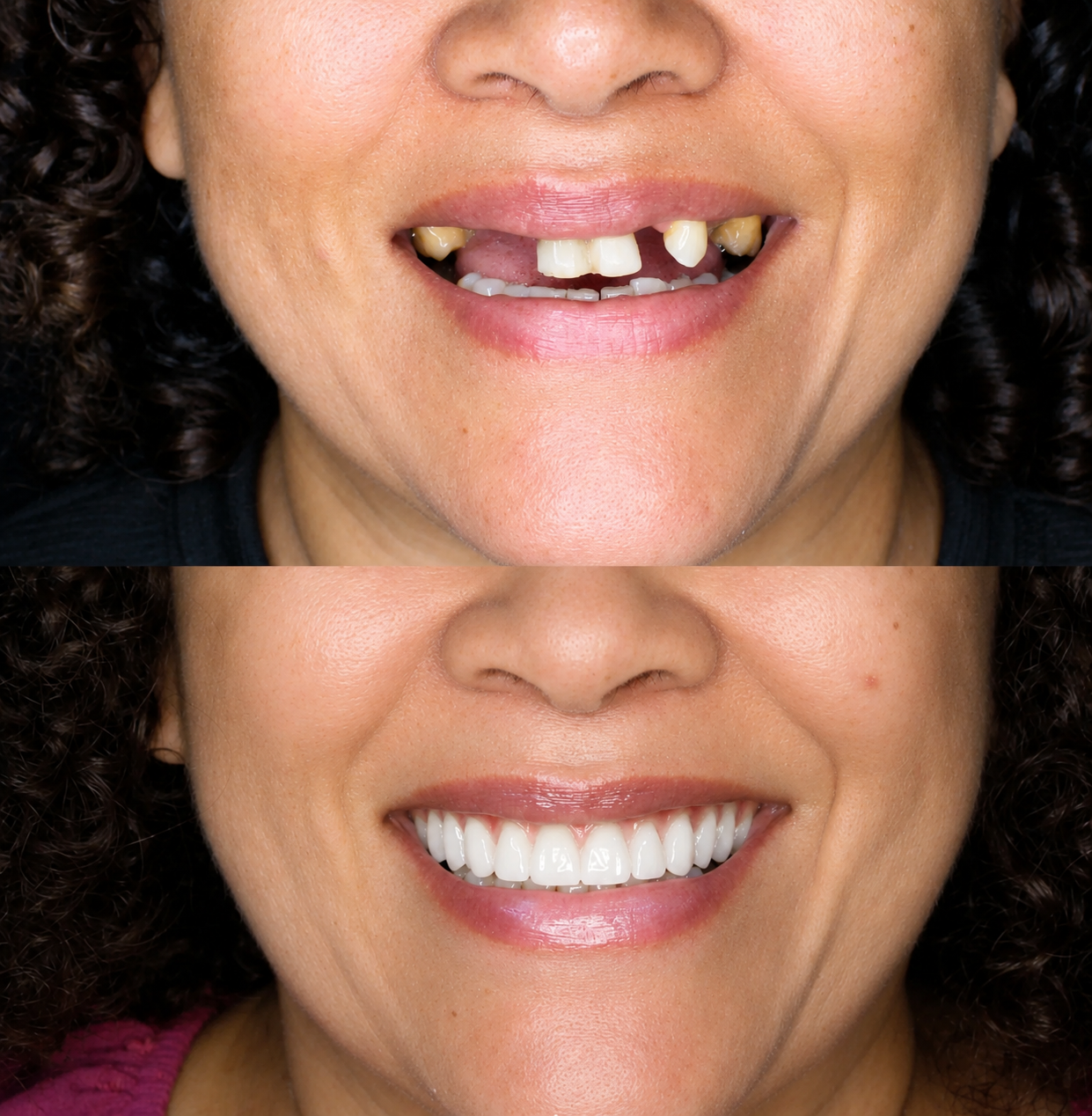 Antes e depois — reabilitação com implantes dentários